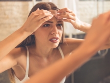 5 טיפים לטיפול טבעי באקנה